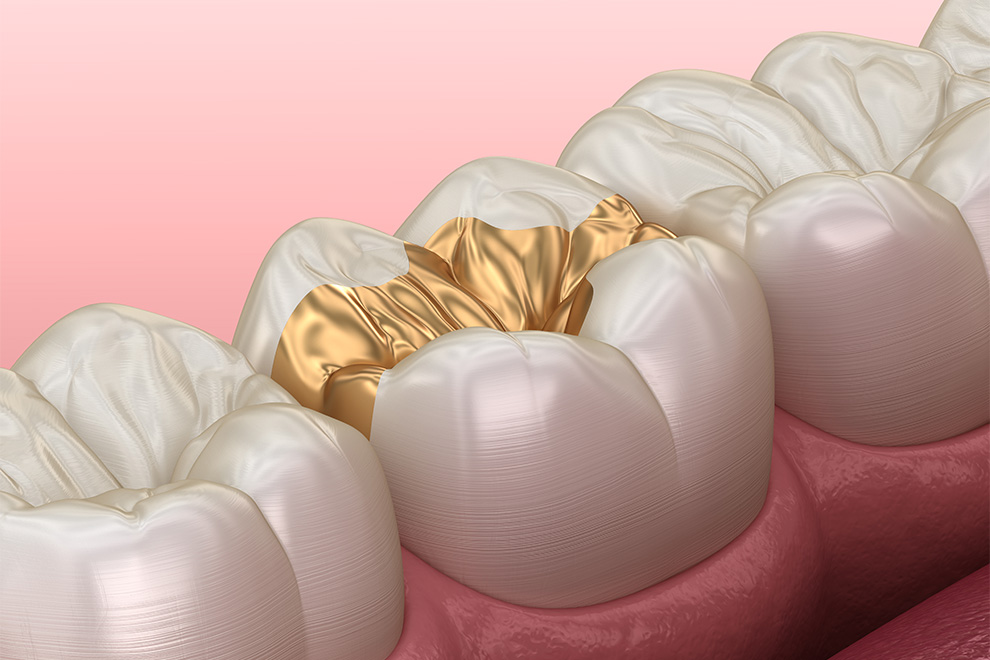 ゴールドインレー（20K）