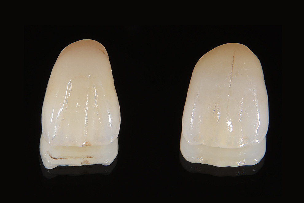 ホワイトジルコニア