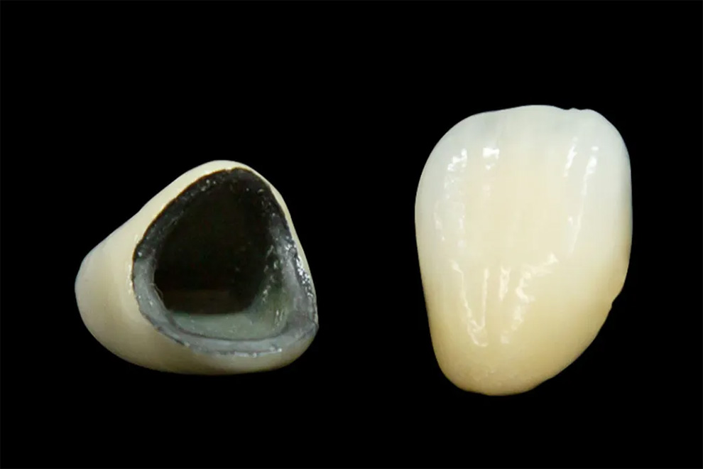 セミプレシャスメタル