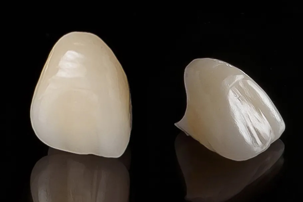 硬質レジン前装クラウン